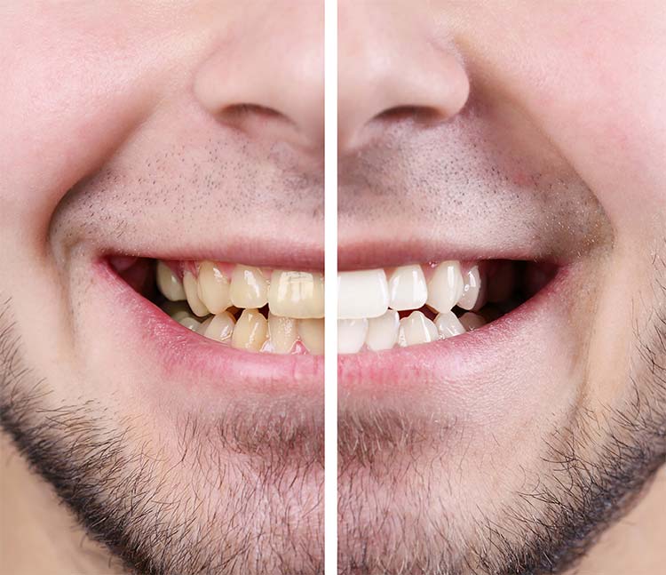 Teeth before after man