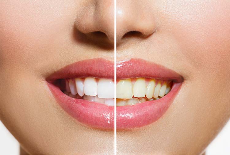 Teeth before after woman